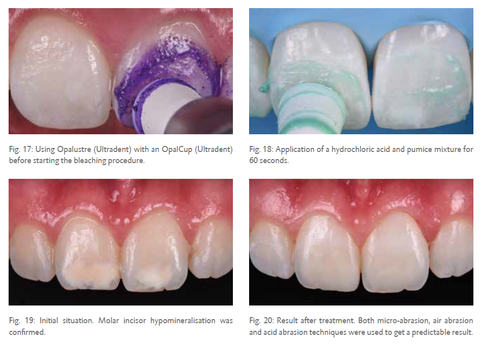 Fig. 17: Using Opalustre (Ultradent) with an OpalCup (Ultradent) before starting the bleaching procedure.  Fig. 19: Initial situation. Molar incisor hypomineralisation was confirmed.  Fig. 18: Application of a hydrochloric acid and pumice mixture for 60 seconds.   Fig. 20: Result after treatment. Both micro-abrasion, air abrasion and acid abrasion techniques were used to get a predictable result.